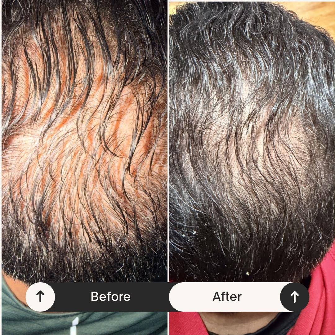 PRP Hair Restoration — before and after result at A&A Medical Aesthetics