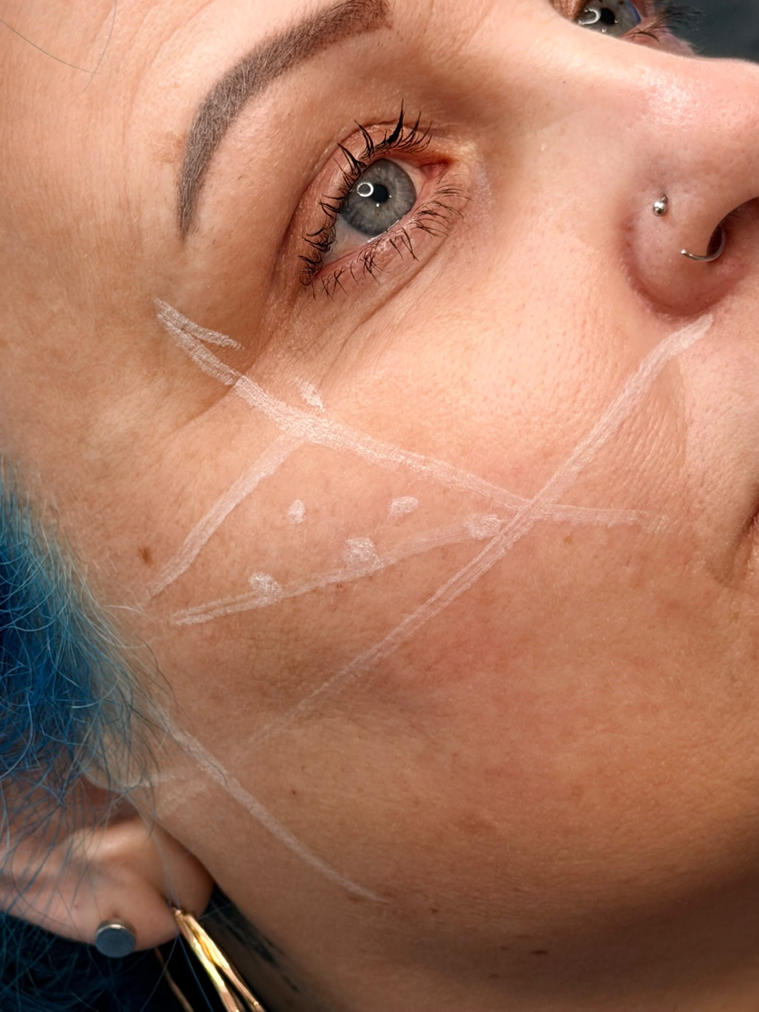 Treatment being carried out at A&A Medical Aesthetics
