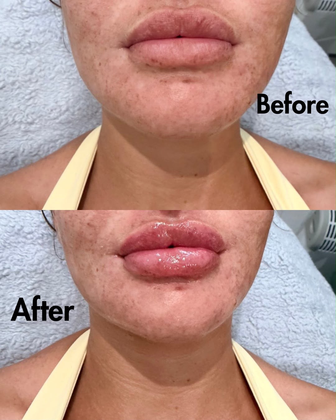 Lip Enhancement — before and after result at A&A Medical Aesthetics