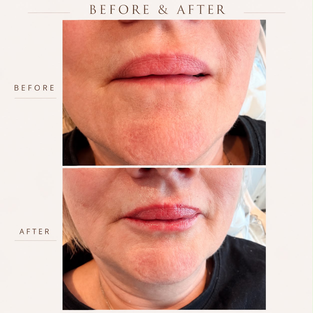 Lip Enhancement — before and after result at A&A Medical Aesthetics