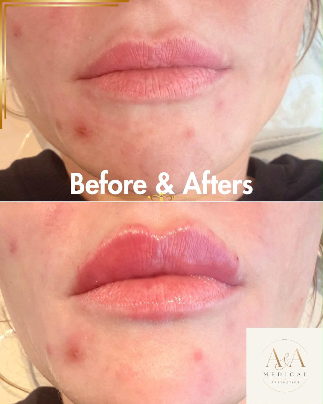 Lip Enhancement — before and after result at A&A Medical Aesthetics