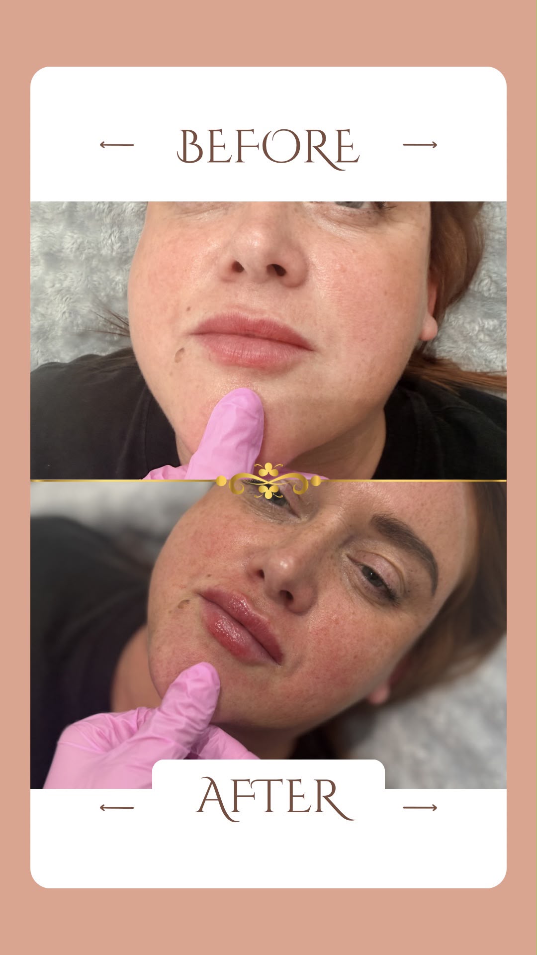 Facial Contour Enhancement — before and after result at A&A Medical Aesthetics