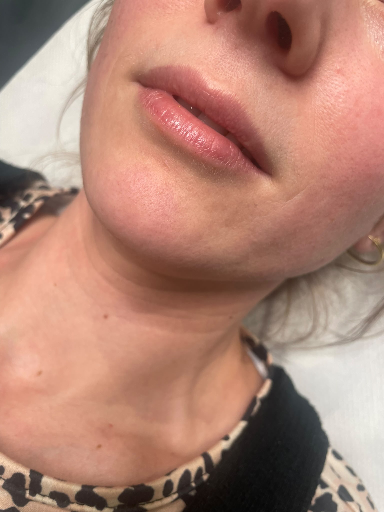 Lip Enhancement — before